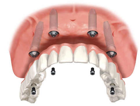 Studio dentistico ROSATI - Trattamenti personalizzati